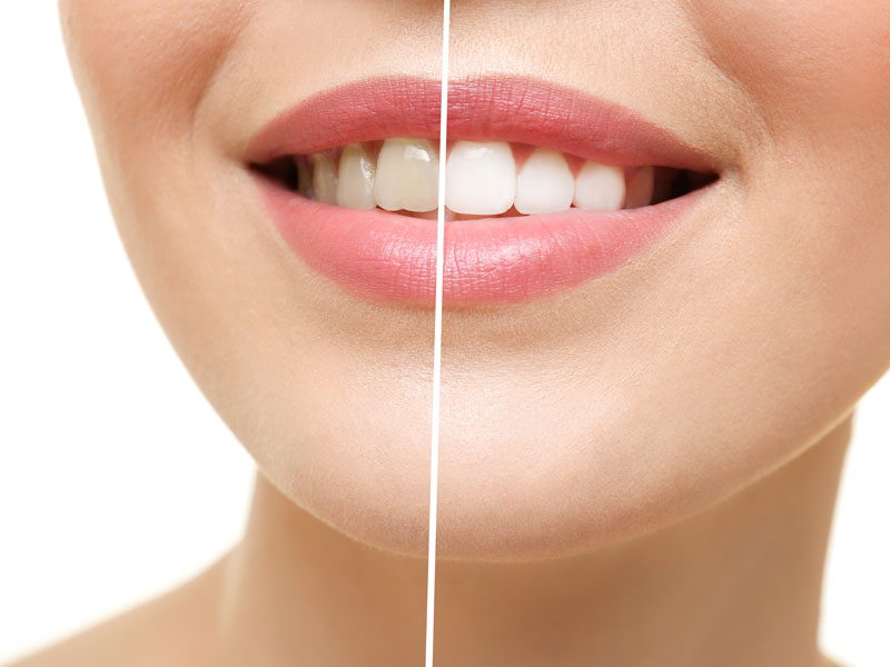 Happy Patient with Whiter Teeth